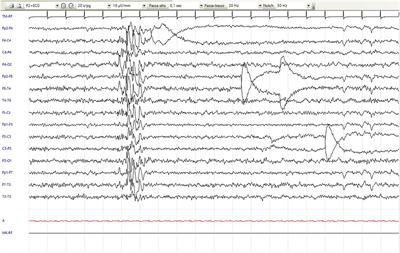 Case report: Expanding the phenotype of FOXP1-related intellectual disability syndrome and hyperkinetic movement disorder in differential diagnosis with epileptic seizures